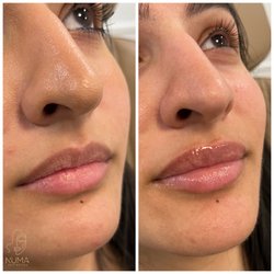 Numa Aesthetics - Lip enhancement.