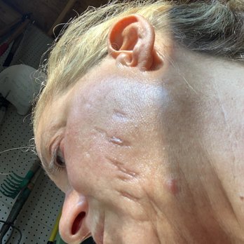 Evolution Medical Spa - I am embarrassed to show the right side of my face, even to this day. - Medical Spas Near Me - Shelby Township, Michigan