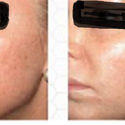 DermaScience Skin Clinic - Microneedle
Before and After - perfect solution to address acne scarring