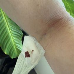 Quest Diagnostics - Arm where blood was drawn.