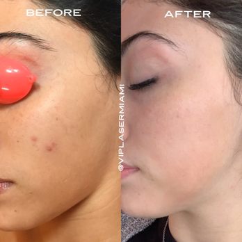 VIP Laser - Dermapen before and after! - Medical Spas Near Me - Miami, Florida VIP Laser - Dermapen before and after! - Medical Spas Near Me - Miami, Florida