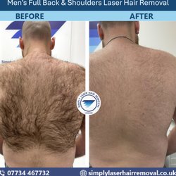 Simply Laser Hair Removal and Skin Clinic - Before&after results showing major reduction in back&shoulder hair. Laser hair removal delivers smoother skin & noticeably lighter regrowth