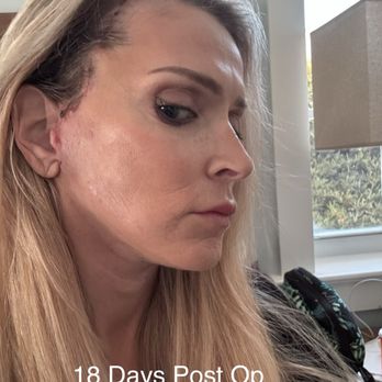 ARC Plastic Surgery: Jeremy White, M.D - 18 days post op - Cosmetic Surgeons Near Me - Miami, Florida ARC Plastic Surgery: Jeremy White, M.D - 18 days post op - Cosmetic Surgeons Near Me - Miami, Florida