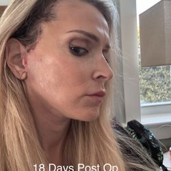 ARC Plastic Surgery: Jeremy White, M.D - 18 days post op