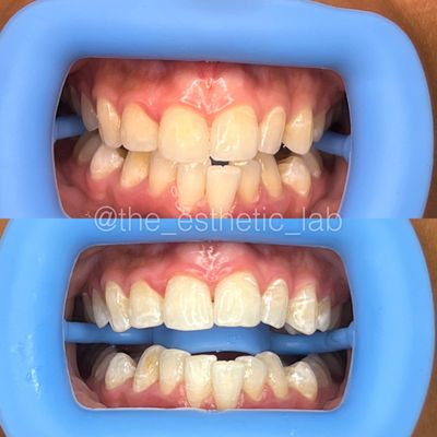 Teeth Whitening - Need a brighter smile for an upcoming event? Come visit The Esthetic Lab and achieve a brighter smile in a quick session.