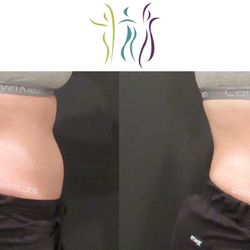 The Skin Studios Advanced Aesthetics and Anti-Aging - TruSculpt fleX muscle sculpting at work!