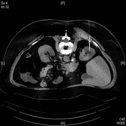 Ari Kostadaras, MD - Kidney biopsy