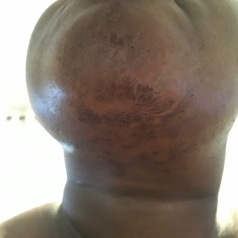 SEV Laser - They burned my chin and wouldn't make it right. Not even a courtesy discount on my next appt. Just blamed it on ME. My chin is still raw. - Medical Spas Near Me - West Hollywood, California SEV Laser - They burned my chin and wouldn't make it right. Not even a courtesy discount on my next appt. Just blamed it on ME. My chin is still raw. - Medical Spas Near Me - West Hollywood, California