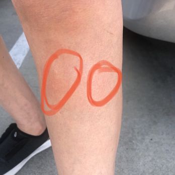 Ancient  Massage - 2 bites on my left leg, this was also in the parking lot in the back - Massage Near Me - San Gabriel, California