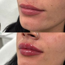 Lip Filler