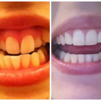 Central Florida Orthodontic Specialists - Dr. Kopuri did an amazing job! Absolutely love my new smile! A big thank you to him and his excellent staff! - Orthodontists Near Me - Melbourne, Florida Central Florida Orthodontic Specialists - Dr. Kopuri did an amazing job! Absolutely love my new smile! A big thank you to him and his excellent staff! - Orthodontists Near Me - Melbourne, Florida