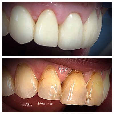 LA Smiles Dentistry - LA Smiles Dentistry LA Smiles Dentistry - LA Smiles Dentistry