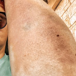 Left forearm injury from falling onto concrete edge.