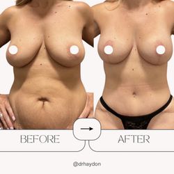 Austin Plastic Surgery Institute & Skin Care Clinic - Mommy makeover by Dr. Scott Haydon.