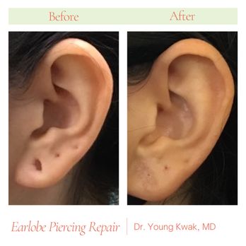 Good Dermatology - Earlobe Piercing Repair by Dr. Young Kwak - Dermatologists Near Me - Torrance, California Good Dermatology - Earlobe Piercing Repair by Dr. Young Kwak - Dermatologists Near Me - Torrance, California