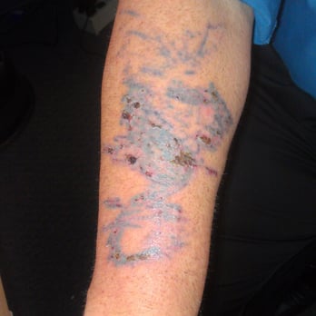 Hindsight Tattoo Removal - After 2nd treament - Tattoo Removal Near Me - Chicago, Illinois