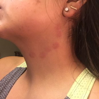 LaserAway - Burns from the machine. Interrupted, the nurse then review my chart and apologized. They didn't bother to help treat the issue. - Medical Spas Near Me - Pasadena, California
