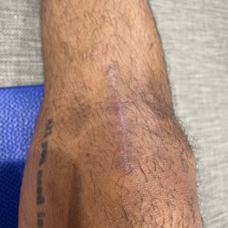 Neal Berger, MD - In a few months you probably wouldn't know I had surgery. (Right knee)
