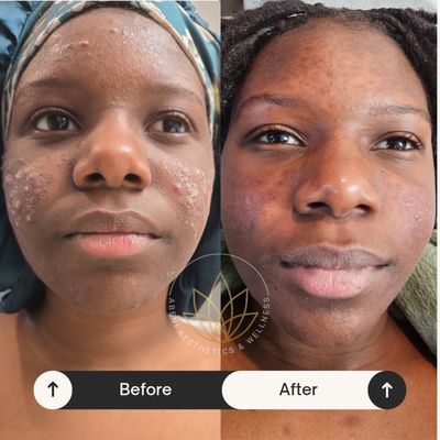 Skincare, HydroDiamond Facials, NouvaDerm Laser - A collection of before-and-after results highlighting transformations in acne, hyperpigmentation, and aging concerns. We preformed treatments including chemical peels, microneedling, HydroDiamond Facials, and NouvaDerm Laser.
