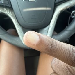 Right pinky. Nail cut below skin line Right pinky. Nail cut below skin line