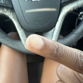 Pretty Nails - Right pinky. Nail cut below skin line - Nail Salons Near Me - Indianapolis, Indiana Pretty Nails - Right pinky. Nail cut below skin line - Nail Salons Near Me - Indianapolis, Indiana