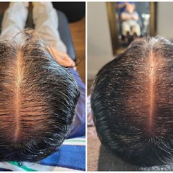 Damo Hair Loss Solution