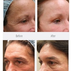 The Shoreline Center for Laser and Cosmetic Surgery - Brow Lift