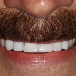 Donald S Clem III, DDS - Regenerative Solutions - After, all six front teeth are crowns on implants