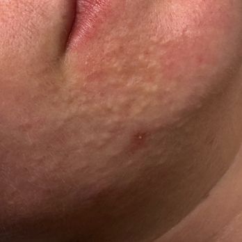 Skinterest Regenerative Esthetics - Before - Skin Care Near Me - Laguna Niguel, California