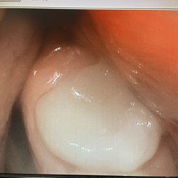 Keith C Henderson, DDS APDC - After! No more fracture or decay! This is the partial crown!