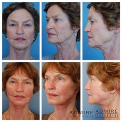 AdmireMD Plastic Surgery + Skin Clinic - Face&neck lift. Eyelids. CO2 laser resurfacing. Great, natural results!