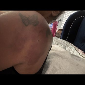Sweet James Accident Attorneys - Bruises - Personal Injury Law Near Me - Ontario, California