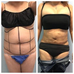WestCoast Lipo