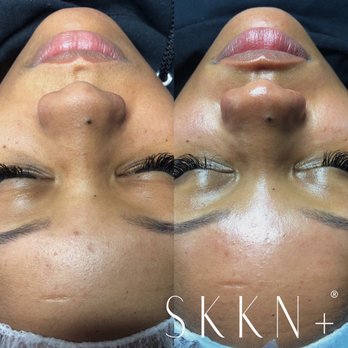 SKKN+ - Microdermabrasion Facial - Skin Care Near Me - Brooklyn, New York SKKN+ - Microdermabrasion Facial - Skin Care Near Me - Brooklyn, New York
