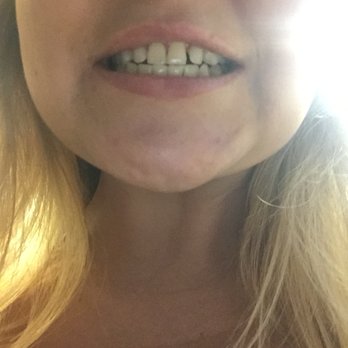 Pure Cypress Dentist - After Dr Ash fixed my gap - No braces or veneers!!!!! - General Dentistry Near Me - Cypress, California Pure Cypress Dentist - After Dr Ash fixed my gap - No braces or veneers!!!!! - General Dentistry Near Me - Cypress, California