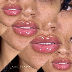 Dosed By Zaza - Fresh lip fillers