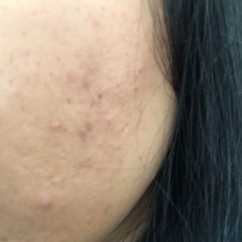 LayLa Threading - These are not pimples. This is what i got from threading yesterday - Threading Services Near Me - Thousand Oaks, California LayLa Threading - These are not pimples. This is what i got from threading yesterday - Threading Services Near Me - Thousand Oaks, California
