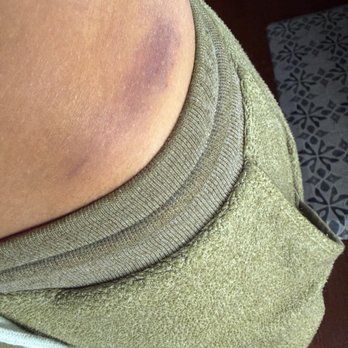 King Tut Hookah Lounge - bruises to hip that extend to knees - Hookah Bars Near Me - Charlotte, North Carolina King Tut Hookah Lounge - bruises to hip that extend to knees - Hookah Bars Near Me - Charlotte, North Carolina