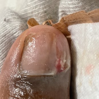 167 Foxy Nails - My toe nail after the podiatrist removed  the infected portion - Nail Salons Near Me - The Bronx, New York