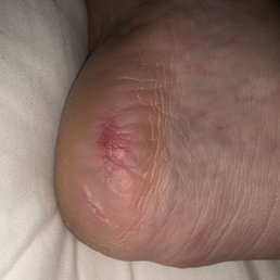 One of the 3 sores on my feet