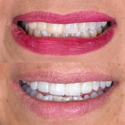 Arcade Dental - Pharr - Here we replaced a failing bridge and matched her existing teeth!