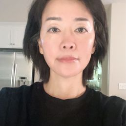 56 year old, after two PicoSure treatments. 56 year old, after two PicoSure treatments.