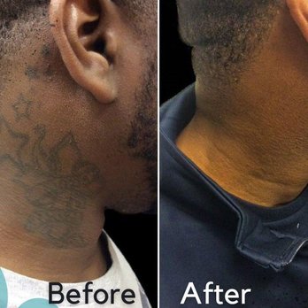 Removery Tattoo Removal & Fading - Tattoo Removal Near Me - Knoxville, Tennessee Removery Tattoo Removal & Fading - Tattoo Removal Near Me - Knoxville, Tennessee