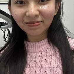Rhema Aesthetics and Wellness - After the microneedling