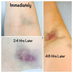 Bruising from intent to draw blood from their "technicians"