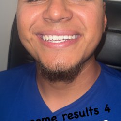 Miriam's teeth whitening