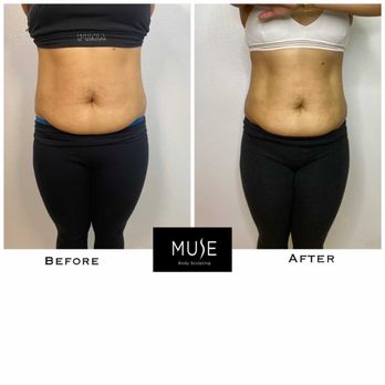 Muse Body Sculpting - Body Contouring Near Me - Signal Hill, California Muse Body Sculpting - Body Contouring Near Me - Signal Hill, California