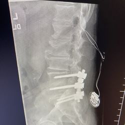 Interventional Spine Medicine - Tim and fusion.