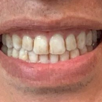The Smile Space - BEFORE veneers... - Orthodontists Near Me - Seattle, Washington