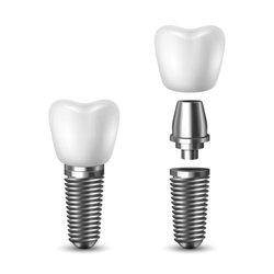 Omaha Dentures And Implants - Single Tooth Dental Implants